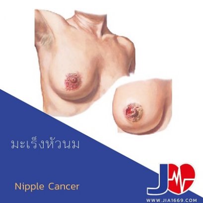 PAGET’S DISEASE OF THE BREAST