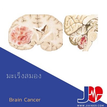 มะเร็งสมอง