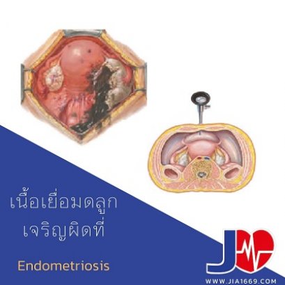 Endometriosis