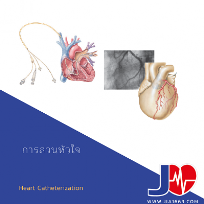 การสวนหัวใจ