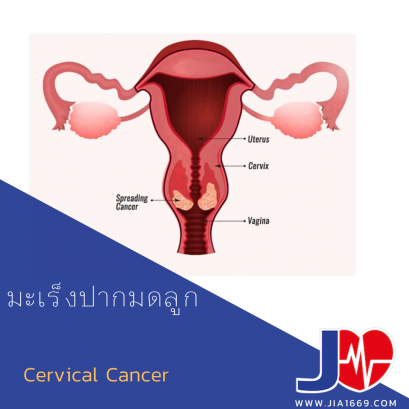 cervical cancer