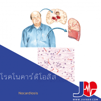 โรคโนคาร์ดิโอสิส