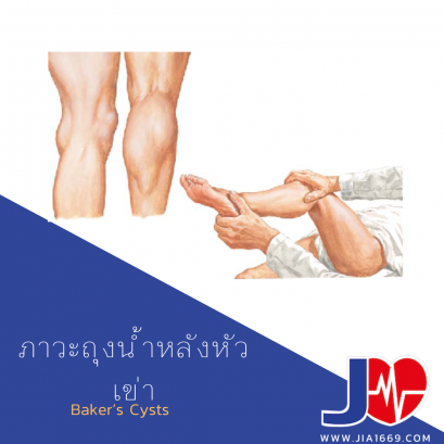 ภาวะถุงน้ำหลังหัวเข่า