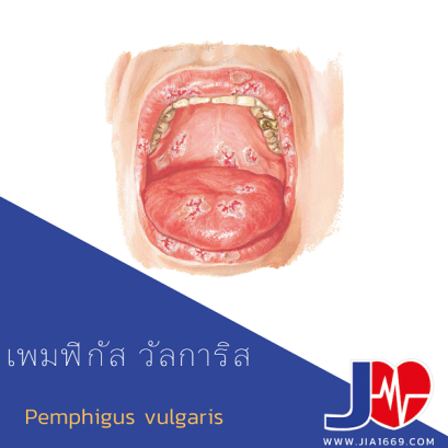 เพมฟิกัส วัลการิส