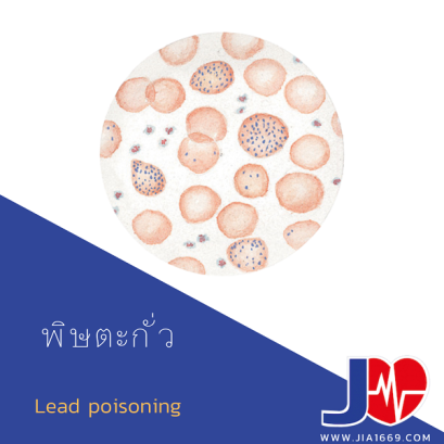 พิษตะกั่ว 