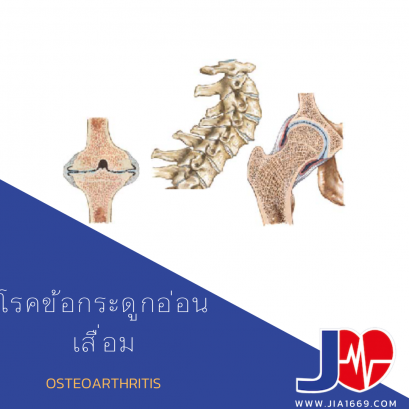 โรคข้อกระดูกอ่อนเสื่อม 