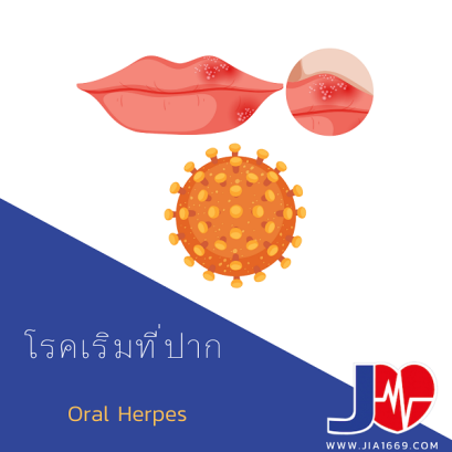 โรคเริมที่ปาก