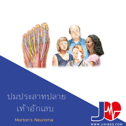 ปมประสาทปลายเท้าอักเสบ