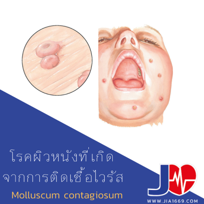 โรคผิวหนังที่เกิดจากการติดเชื้อไวรัส (MCV)