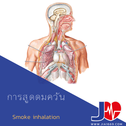 Smoke inhalation