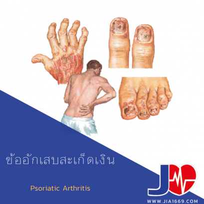 ข้ออักเสบสะเก็ดเงิน