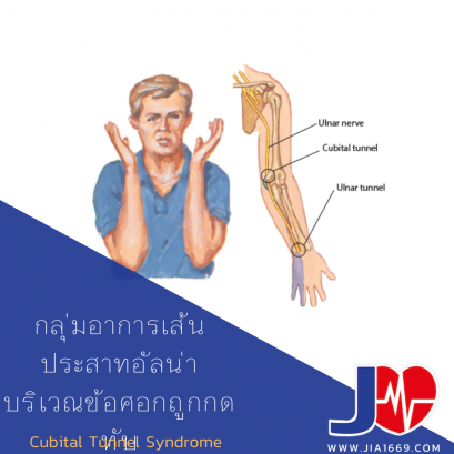 กลุ่มอาการเส้นประสาทอัลน่าบริเวณข้อศอกถูกกดทับ