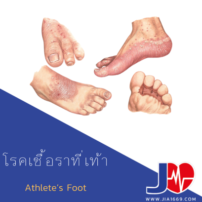โรคเชื้อราที่เท้า