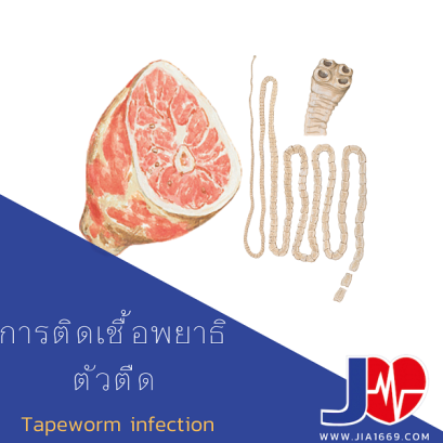 การติดเชื้อพยาธิตัวตืด
