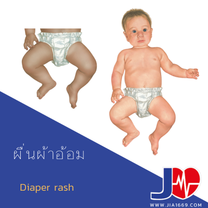 ผื่นผ้าอ้อม