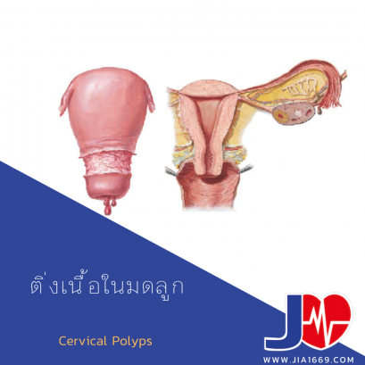 ติ่งเนื้อในมดลูก