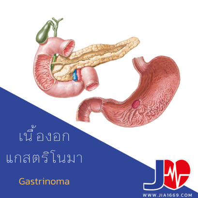 Gastrinoma