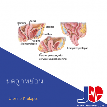 มดลูกหย่อน