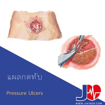 แผลกดทับ