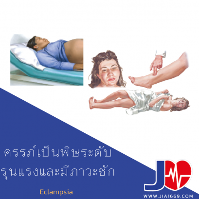 ครรภ์เป็นพิษระดับรุนแรงและมีภาวะชัก