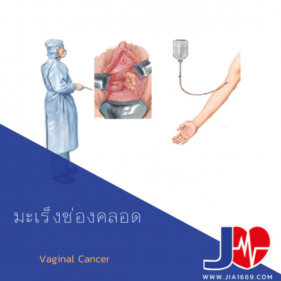 มะเร็งช่องคลอด