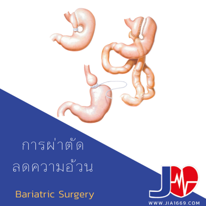 การผ่าตัดลดความอ้วน (Bariatric Surgery)