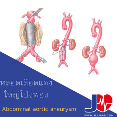 ABDOMINAL AORTIC ANEURYSM