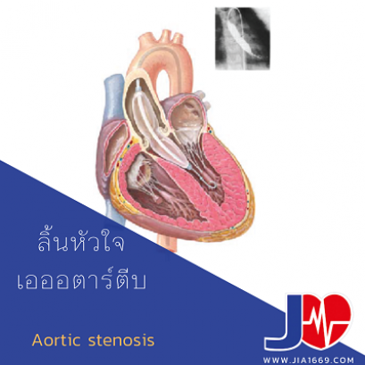 AORTIC STENOSIS