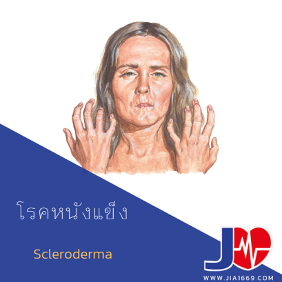 โรคหนังแข็ง