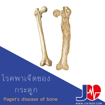 Pagets disease of bone