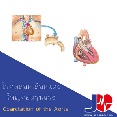 Coarctation of the Aorta 