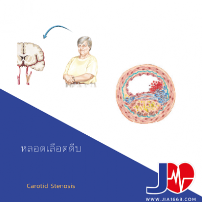 Carotid Stenosis 
