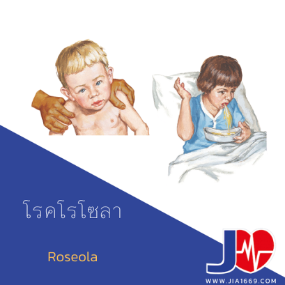 โรคโรโซลา