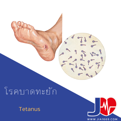 โรคบาดทะยัก (Tetanus)