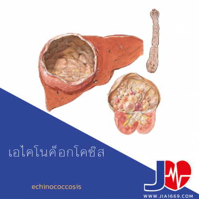 echinococcosis