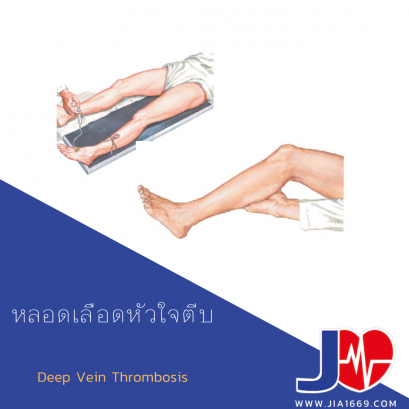 หลอดเลือดหัวใจตีบ