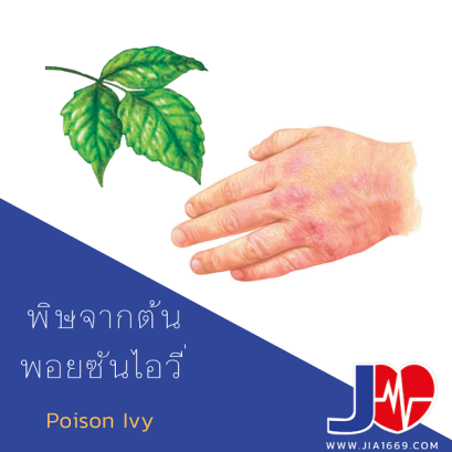 พิษจากต้นพอยซันไอวี่
