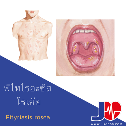 พิไทไรอะซิส โรเซีย