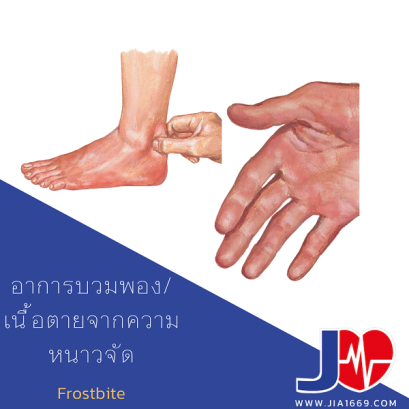 อาการบวมพองเนื้อตายจากความหนาวจัด