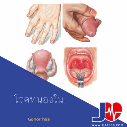 โรคหนองใน