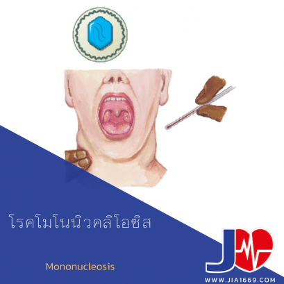 Mononucleosis 