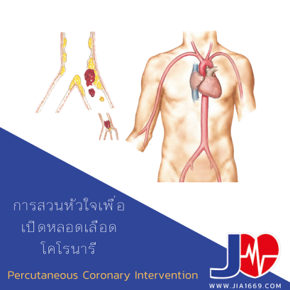 การสวนหัวใจเพื่อเปิดหลอดเลือดโคนารี