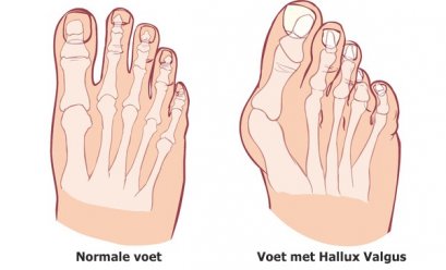 นิ้วโป้งเท้าเก (Hallux Valgus) สาเหตุและวิธีแก้ไข
