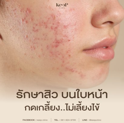 Acne Sure