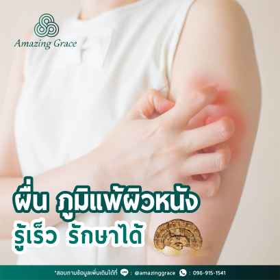 ผื่นภูมิแพ้ผิวหนัง รู้เร็ว รักษาได้ พร้อมสาเหตุและวิธีป้องกันที่ถูกต้อง
