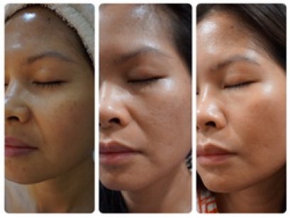 The Scarlett Clinic Siam Paragon Lift Up Face