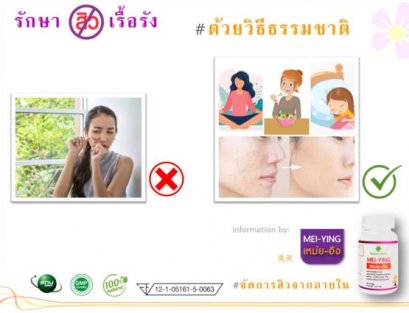 รักษาสิวเรื้อรัง ด้วยธรรมชาติ