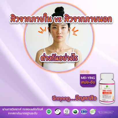 สิวจากภายใน vs สิวจากภายนอก ต่างกันอย่างไร