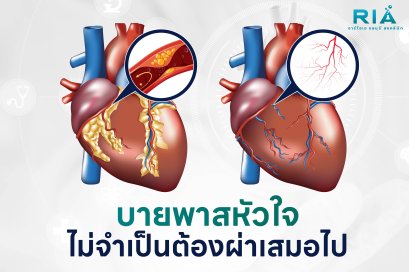บายพาสหัวใจ ไม่จำเป็นต้องผ่าเสมอไป