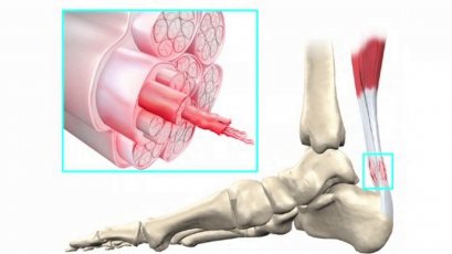 เรียนรู้วิธีการป้องกันและหลีกเลี่ยงอาการเอ็นอักเสบ